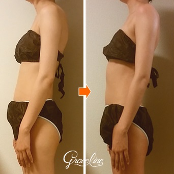 筋膜リリース施術1回姿勢効果　スピリチュアル整体×筋膜リリース　Graceline　グレイスライン