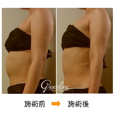 筋膜リリース施術1回お腹効果　スピリチュアル整体×筋膜リリース　Graceline　グレイスライン