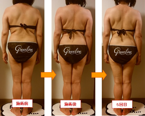 筋膜リリース施術5回効果　スピリチュアル整体×筋膜リリース　Graceline　グレイスライン