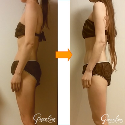 筋膜リリース施術1回姿勢効果　スピリチュアル整体×筋膜リリース　Graceline　グレイスライン