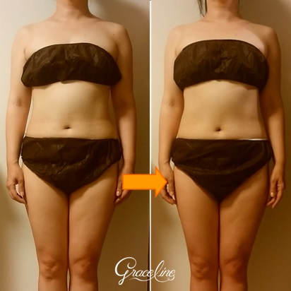 筋膜リリース施術1回効果　スピリチュアル整体×筋膜リリース　Graceline　グレイスライン